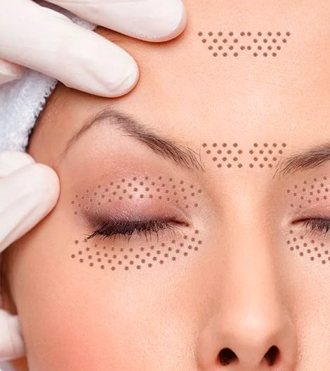 Mujer con tratamiento de plasma pen